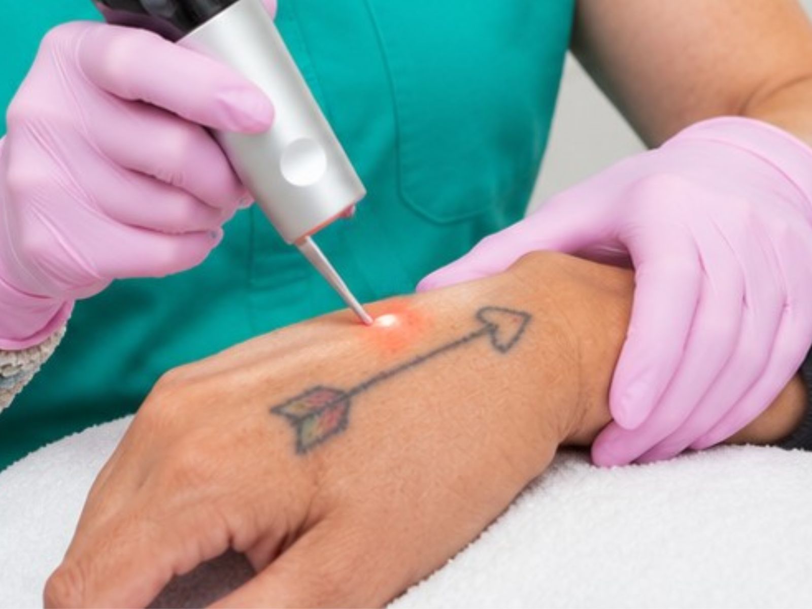 PicoSure tattoo removal treatment at Helio Health and Wellness